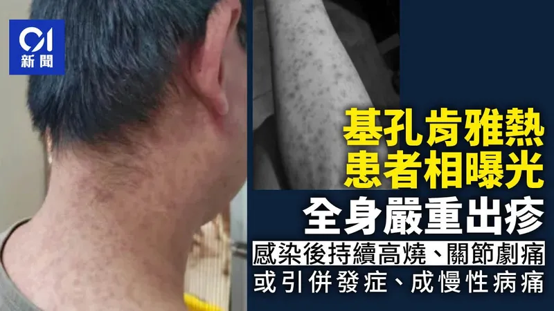 基孔肯雅熱 病徵、傳播途徑與會傳染嗎，部分或發展為嚴重併發症
